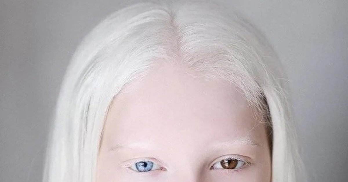 Люди альбиносы: цвет глаз, интересные фото и факты