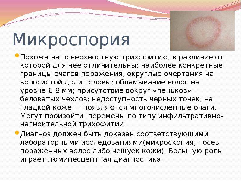 Микроспория (стригущий лишай) кожи и ногтей у детей и взрослых - возбудители инфекции, пути заражения, симптомы, лечение и профилактика, фото
