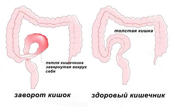 Удлиненный кишечник. Заворот сигмовидной ободочной кишки. Заворот Толстого кишечника. Заворот сигмовидной кишки симптомы. Загиб сигмовидной кишки.