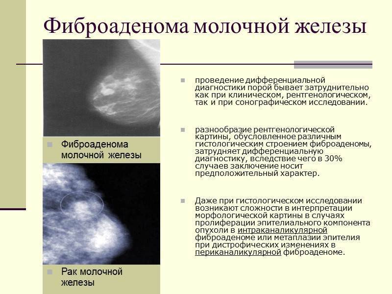 Фиброзно-кистозная мастопатия: диагностика и лечение | пункция молочной железы в санкт-петербурге