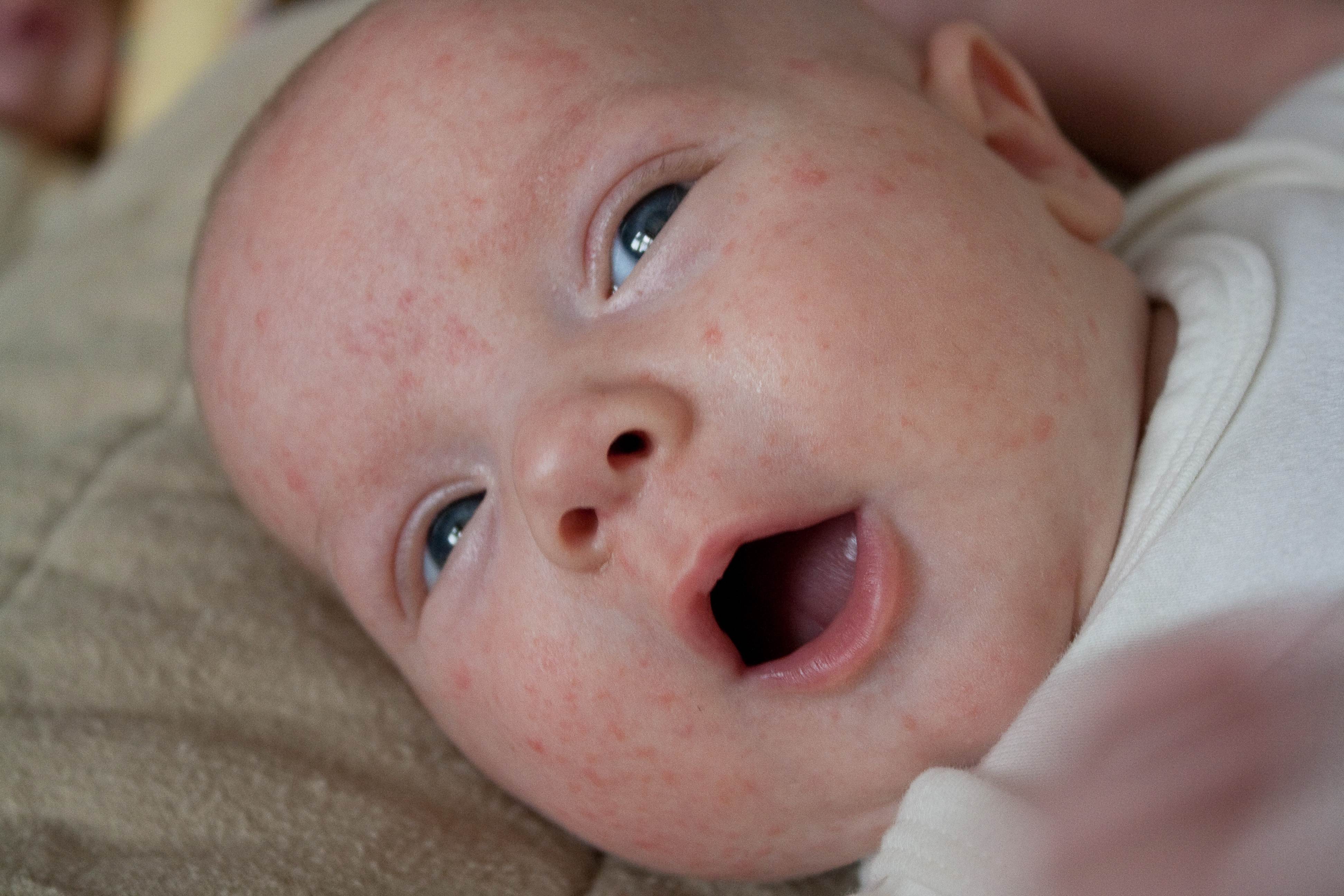 Почему младенцы красные. Неонатальная токсическая эритема. Токсическая эритема новорожденных. Токсическая эритема у младенцев.