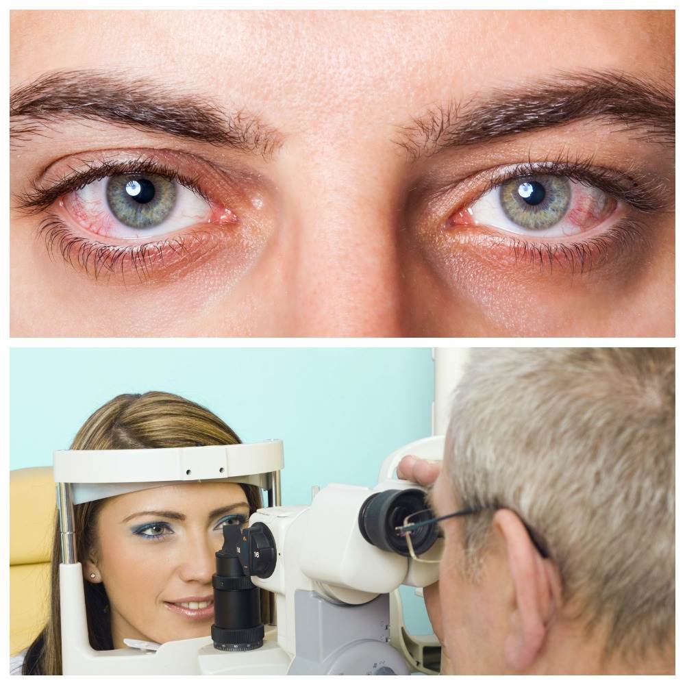 Глазки сухо. Сухие глаза (синдром сухого глаза). Синдром сухого глаза терапия.