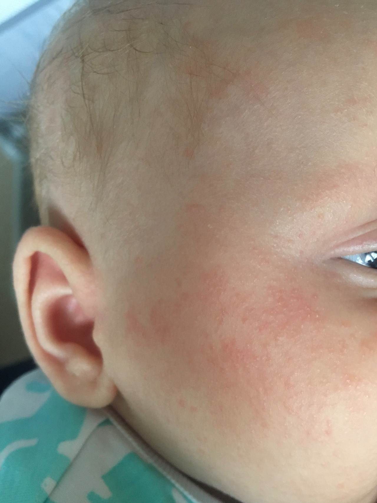 Аллергическая сыпь на лице у малыша