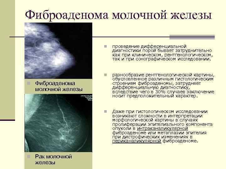 Рак молочной железы: первые признаки и симптомы рака груди, причины появления и стадии опухоли молочной железы | клиники «евроонко»