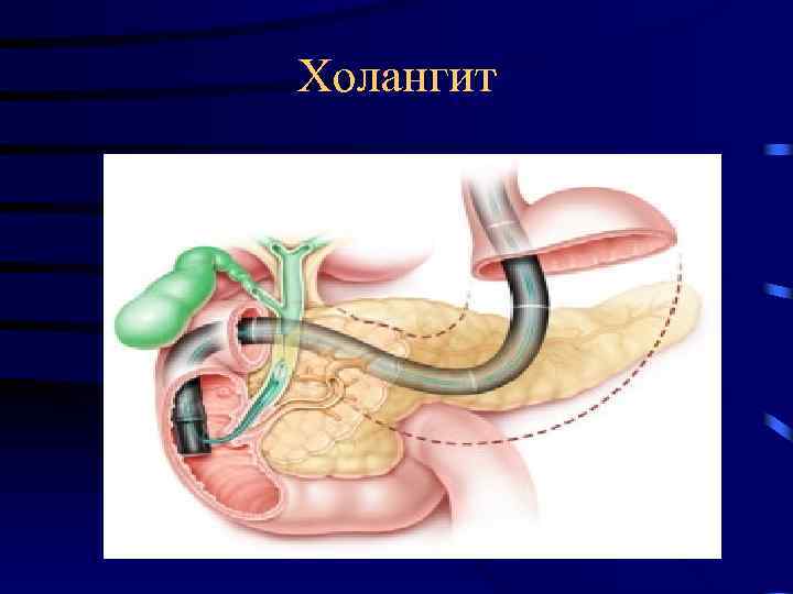 Гнойный холангит презентация