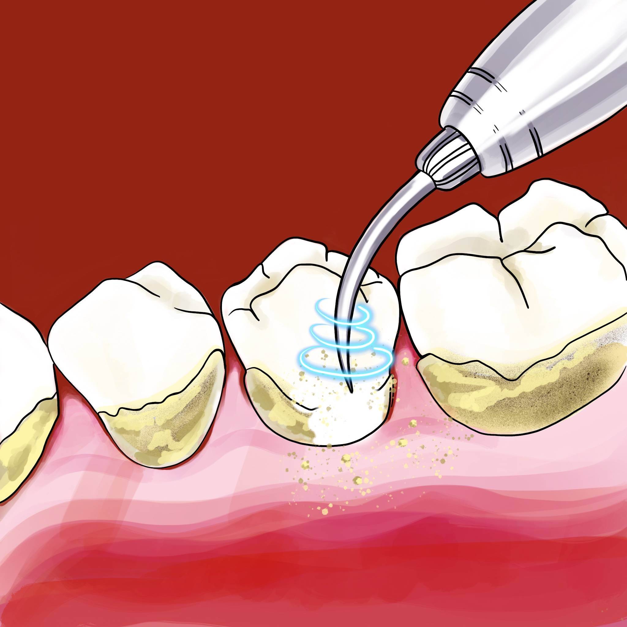 Как делается ультразвуковая чистка зубов, и сколько она стоит