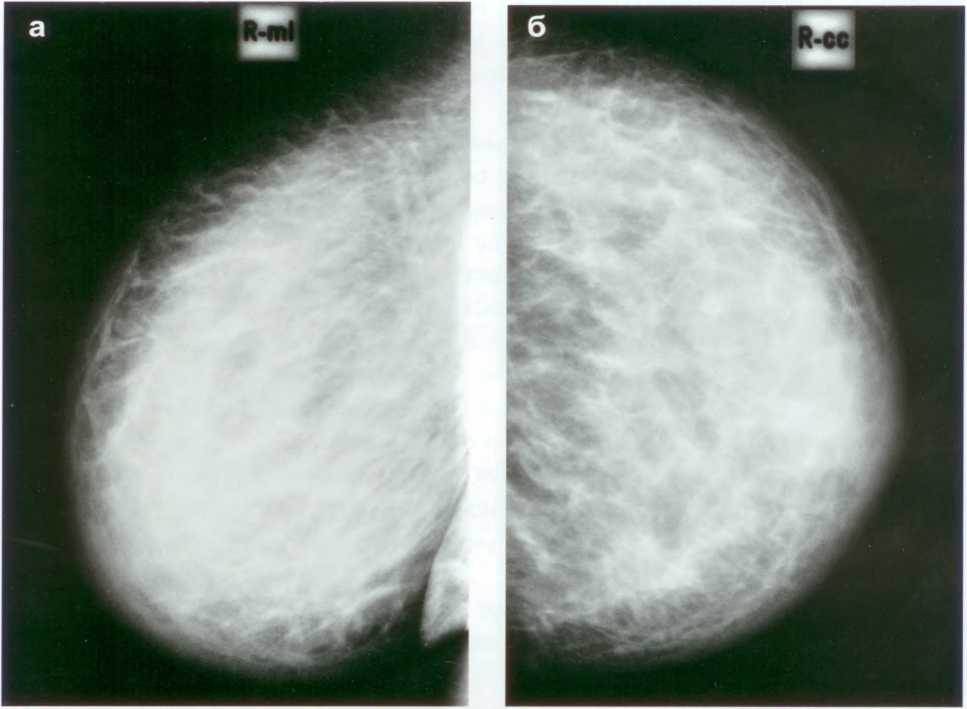 Инфильтративный рак молочной железы фото