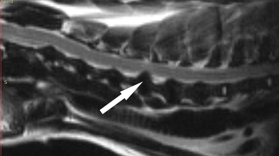 Грыжи диска позвоночника — все способы лечения межпозвоночные грыжи в цэлт.